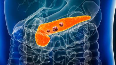 What you need to know about pancreatic cancer